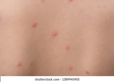 Chickenpox Images Stock Photos Vectors Shutterstock