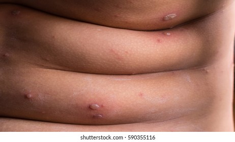 Chicken Pox Rash, Viral Infections Or Chickenpox Disease, Closeup