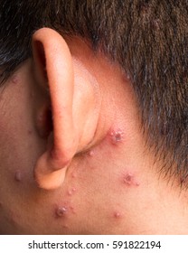 Chicken Pox Rash, Viral Infections Or Chickenpox Disease, Closeup