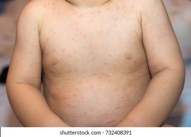 デング熱ウイルス デング熱出血熱 による赤ちゃんの皮膚の赤い斑点写真素材 Shutterstock