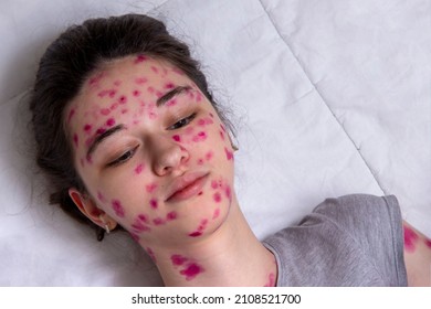 918 Adult chickenpox Images, Stock Photos & Vectors | Shutterstock