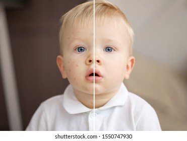 Chickenpox Child, Smallpox, Mosquito Bite, Allergic Reaction, Before And After Recovery