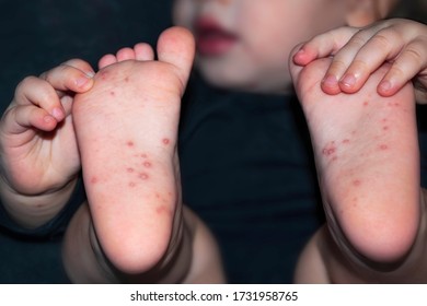 Chickenpox Disease Baby Has Acne On Stock Photo (edit Now) 1731958765