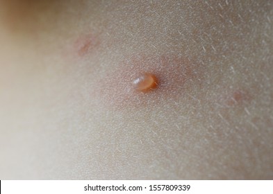 chicken-pox papule (spot) macro, closeup
