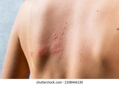chickenpox rash. Shingles, varicella-zoster virus. skin rash and blisters on body. Skin infected Herpes zoster virus. Herpes Virus on body. urticaria rash. atopic dermatitis. - Shutterstock ID 2108446130