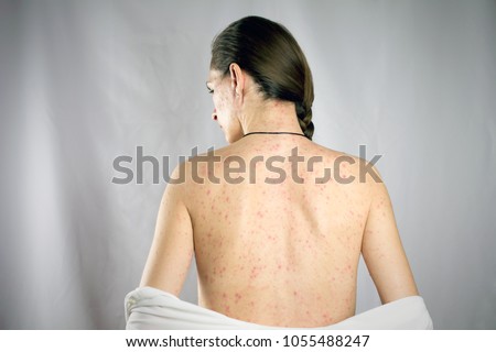 chickenpox viral infection concept. girls back skin rashes