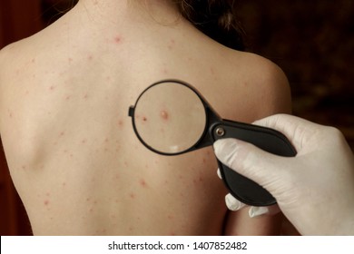 Chickenpox Images Stock Photos Vectors Shutterstock