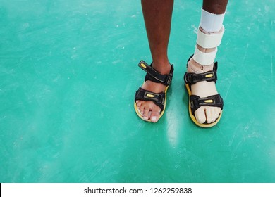 Child Amputee At Ankle Level Standing With Prosthesis On Green Cement Floor.                  