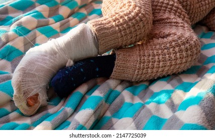 Child With Bandage On Leg Heel Fracture. Broken Right Foot, Bone, Calf, Ankle, Leg In Plaster, Splint Of Toddler. Little Boy Sleeping On A Blue Blanket. Human Healthcare And Medicine Concept