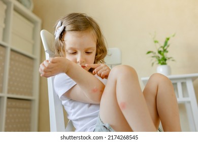 A Child Bitten By Mosquitoes And Insects Applies Cream To Wounds. First Aid And Remedy For Allergy To Insect Bites And For Wound Healing