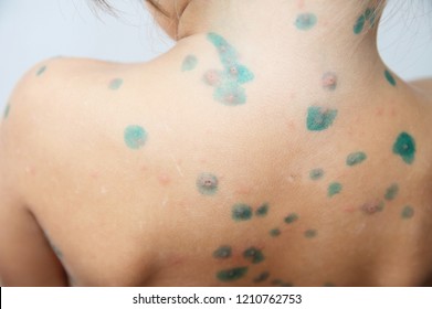 Child dorsum with chickenpox. Sick little girl  with varicells making eruption on skin. Long home quarantine, then having immunity for ever.