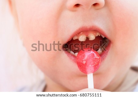 Child eats candy. Girl has caries on teeth. 