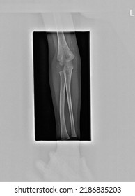 Child Elbow Joint With Proximal Radius Ulna Radiograph 