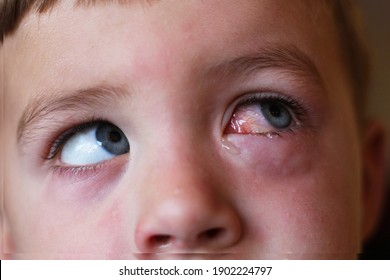 Child With Eye Infection , Redness Of The Eye. Baby With Pinkeye. Red Eye.