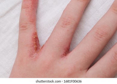 Child Hand Witn Eczema, Atopic Dermatitis Between Fingers.