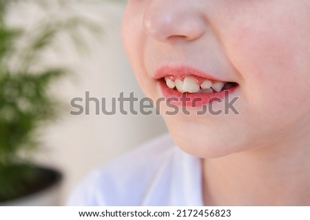Child has crooked teeth. The concept of crowding of molars.