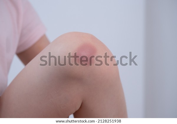 The child is\
holding on to a bruised knee. A teenager girl hurt her leg.\
Bruising in the knee area,\
injury
