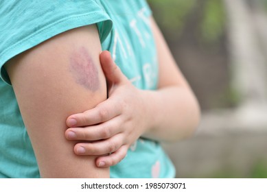 The Child Is Holding On To A Large Bruise On His Arm