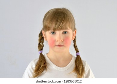 Child, Kid, Has Red Cheeks Skin Irritation