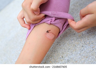 Child Leg wounds caused by hot blanching from motorcycle exhaust pipes. - Shutterstock ID 2168607605