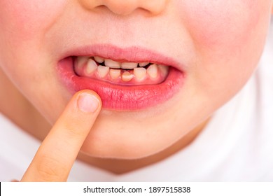 Child Loose Tooth. Little Boy 6 Years Old Loose Baby Tooth Incisor. Kids Dental Medicine And Oral Hygiene Concept. Emotions Of Child. Close Up Portrait