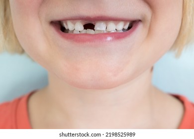 Child Lost A Deciduous Teeth, Close-up. Smiling Kid Without One Tooth.