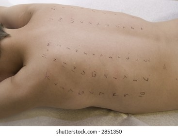 Child Marked For Allergy Test