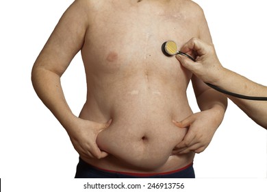 Child Obesity. Scars On The Body Of A Boy Of 11 Years. Pacemaker.Stethoscope Listening To The Heart Doctor.