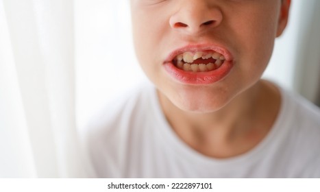 Child Open Bite Or Maloccusion Due To Thumb Sucking. Close Up Of Youngster Face With Crooked Teeth Before Install Braces