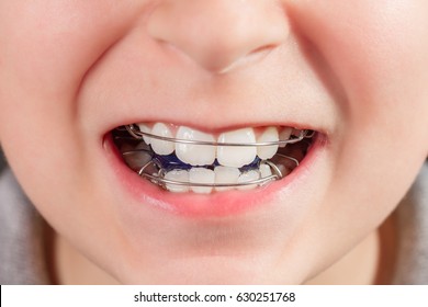 Child With Orthodontic Appliance Close-up