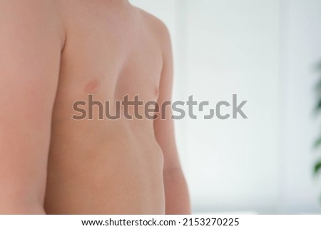 A child with a pectus excavatum. Rickets is a consequence of vitamin D deficiency.