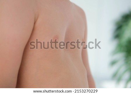 A child with a pectus excavatum. Rickets is a consequence of vitamin D deficiency.