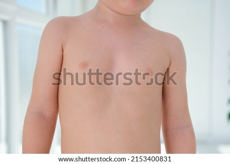 A child with a pectus excavatum. Rickets is a consequence of vitamin D deficiency.