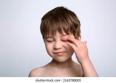 Child with red swollen eye from insect bite. Quincke edema. Portrait of unhappy caucasian appearance boy. Isolated background. Face of allergic person. Copy space. Studio. Allergy. Sick body part. - Shutterstock ID 2143788005