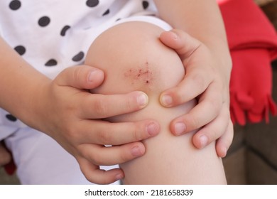 Child With Scraped Knee, Injury After Falling. Scratched Skin On Toddler's Knee.	