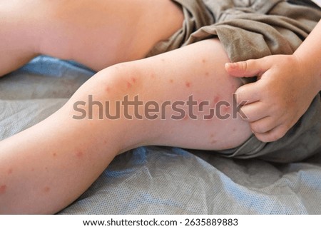 Child scratch body has sensitive itchy skin. Bodily rash. Kid allergy closeup. Little baby scratches eruption. Irritation, hive. Pruritus. Mosquito insect bite. Red from sunburn, Seborrheic Dermatitis