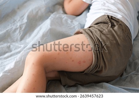 Child scratch body has sensitive itchy skin. Bodily rash. Kid allergy closeup. Little baby scratches eruption. Irritation, hive. Pruritus. Mosquito insect bite. Red from sunburn, Seborrheic Dermatitis