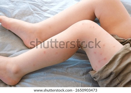 Child scratch body has sensitive itchy skin. Bodily rash. Kid allergy closeup. Little baby scratches eruption. Irritation, hive. Pruritus. Mosquito insect bite. Red from sunburn, Seborrheic Dermatitis