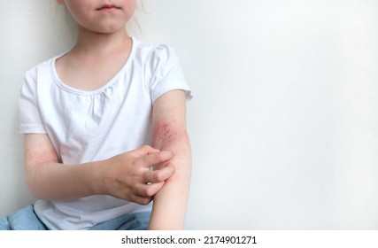 The Child Scratches Atopic Skin. Dermatitis, Diathesis, Allergy On The Child's Body.