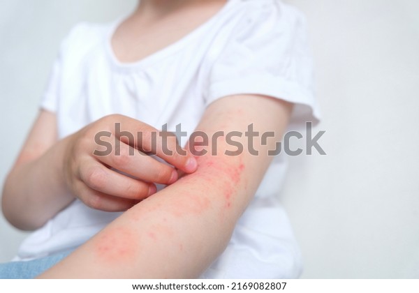The child scratches\
atopic skin. Dermatitis, diathesis, allergy on the child\'s\
body.irritation and\
pruritus.