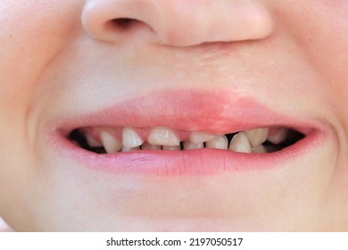 A child shows his crooked teeth. Above the lip is a scar from an operation. Rotated cleft palate pathology