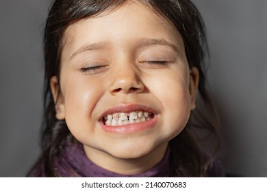 The Child Shows Teeth With Hypoplasia. Pediatric Dentistry And Periodontology, Bite Correction. Health And Dental Care, Caries Treatment, Baby Teeth. Dark Spots On Teeth