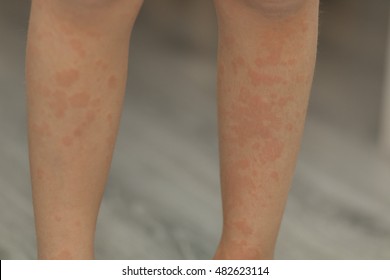 The Child Sick With Measles. Red Spots All Over My Body. Legs, Arms, Back, Stomach. Close-up.