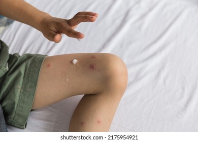 Child Skin Infected With Chickenpox Is Having Treatment Using An