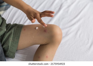 Child Skin Infected With Chickenpox Is Having Treatment Using An