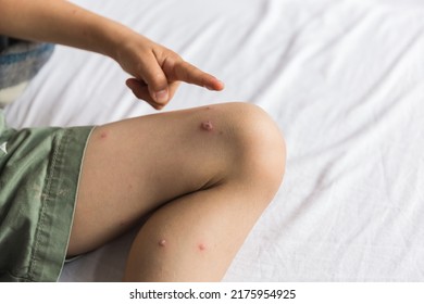 Child Skin Infected With Chickenpox Is Having Treatment Using An