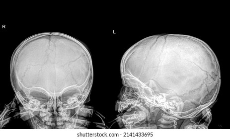 Child skull x-ray with a linear fracture of a left parietal bone.
