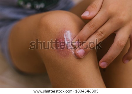 The child smears cream on the damaged skin on the leg. Dry skin and irritation. Allergic reactions. Wound on the knee.