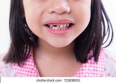 A Child Smile With Missing Teeth