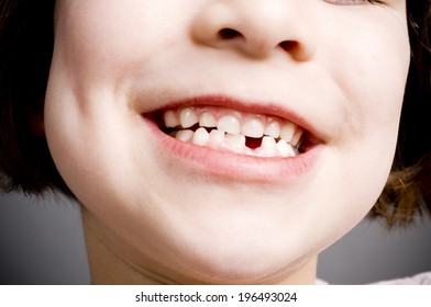 A Child Smiling Showing Off A Missing Tooth.